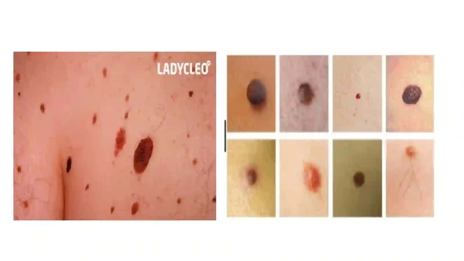 Nevus (xol) 4