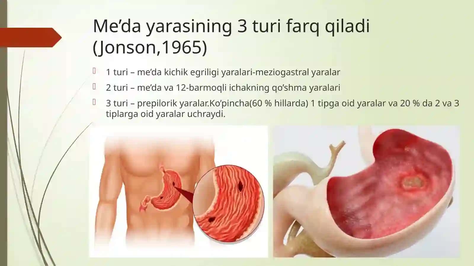 Yara kasalligi.Oshqozon va o'n ikki barmoqli ichak yara kasalligi.Stenoz 4
