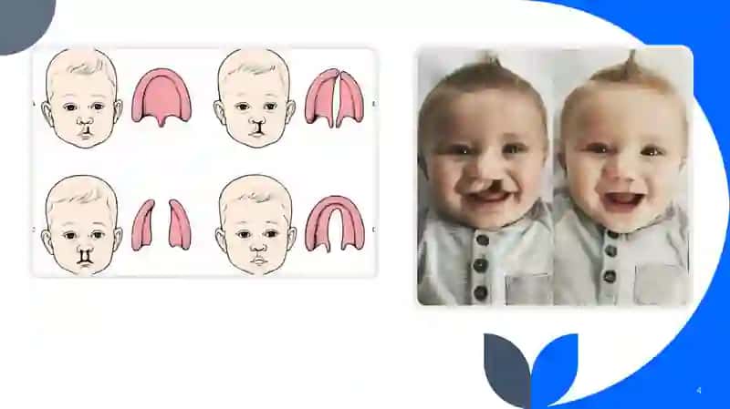 Rinolaliyani bartaraf etish bo’yicha xorij davlatlarida ishlab chiqilgan metodikalarning o’ziga xos xususiyatlari 4