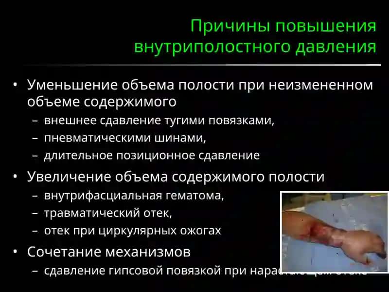 Синдром длительного сдавления 4