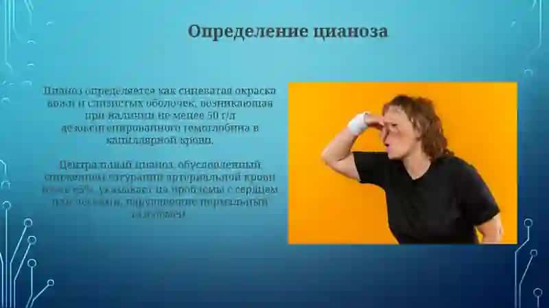Синдромцианоза 4