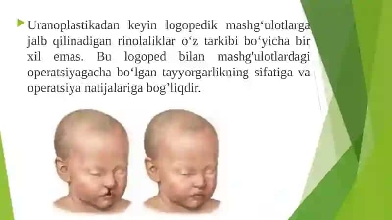 Rinolaliyadaoperatsiyadan keyingi logopedik ishlar 4