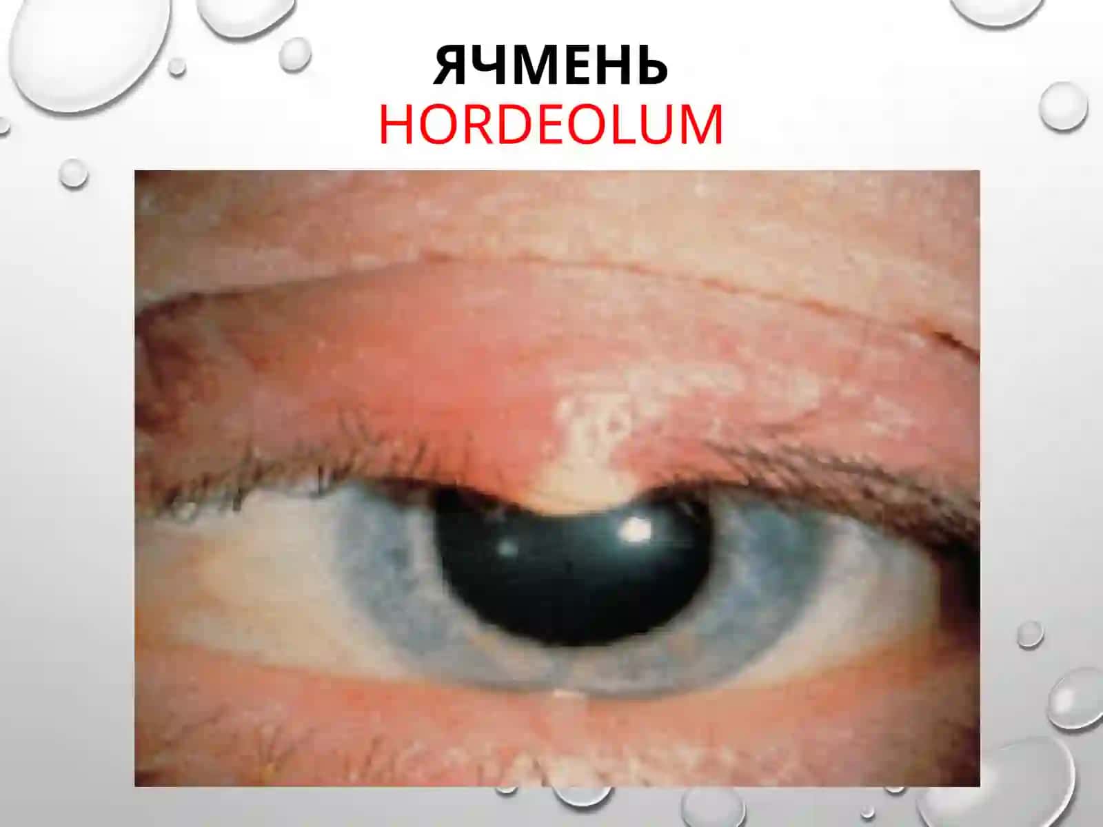 Воспалительные заболевания глаз 4