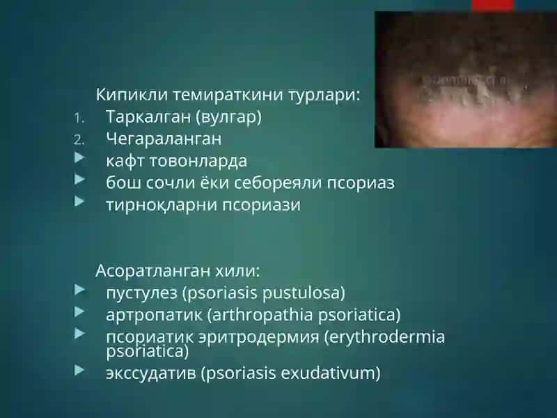 Псориаз 4