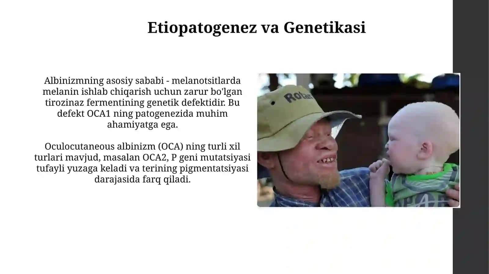 Albinizm etiopotogenezi, klinikasi, diagnostikasi, davolash va profilaktikasi 4