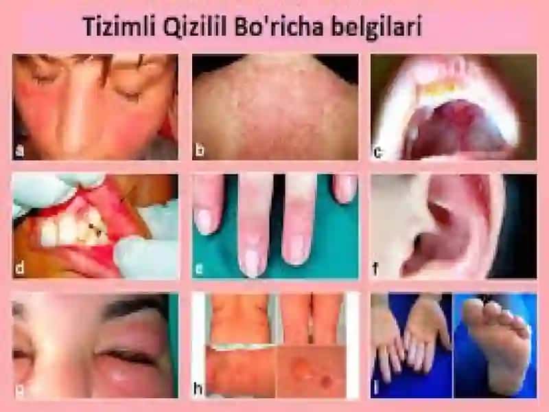 Biriktiruvchi to‘qimaning diffuz kasalliklari 4