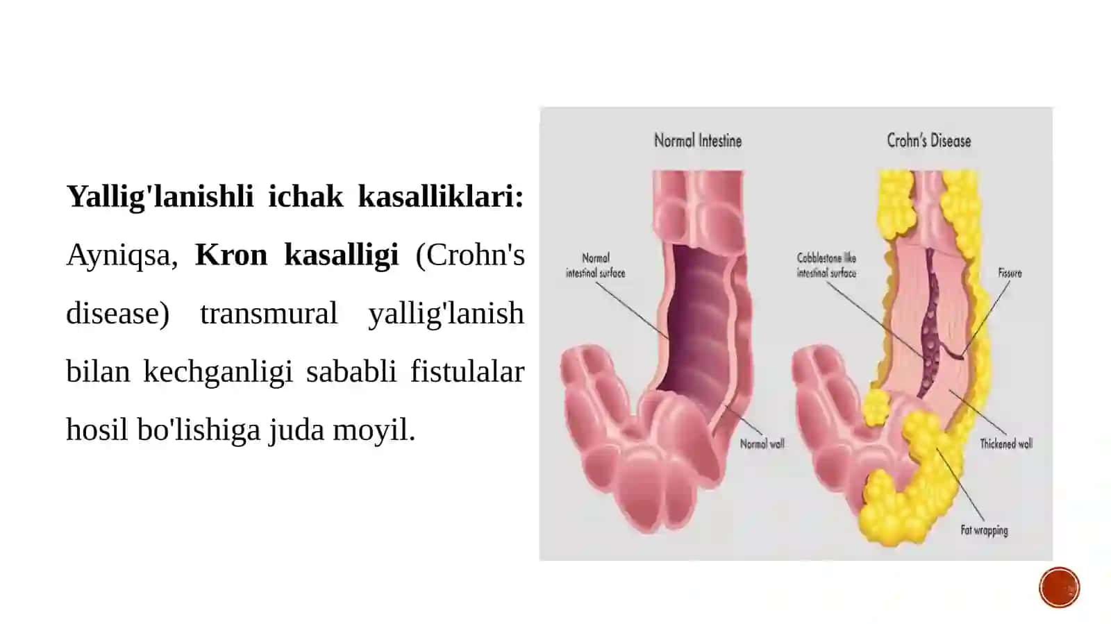 ICHAK OQMA YARALARNI BARTARAF QILISH USULLARI 4
