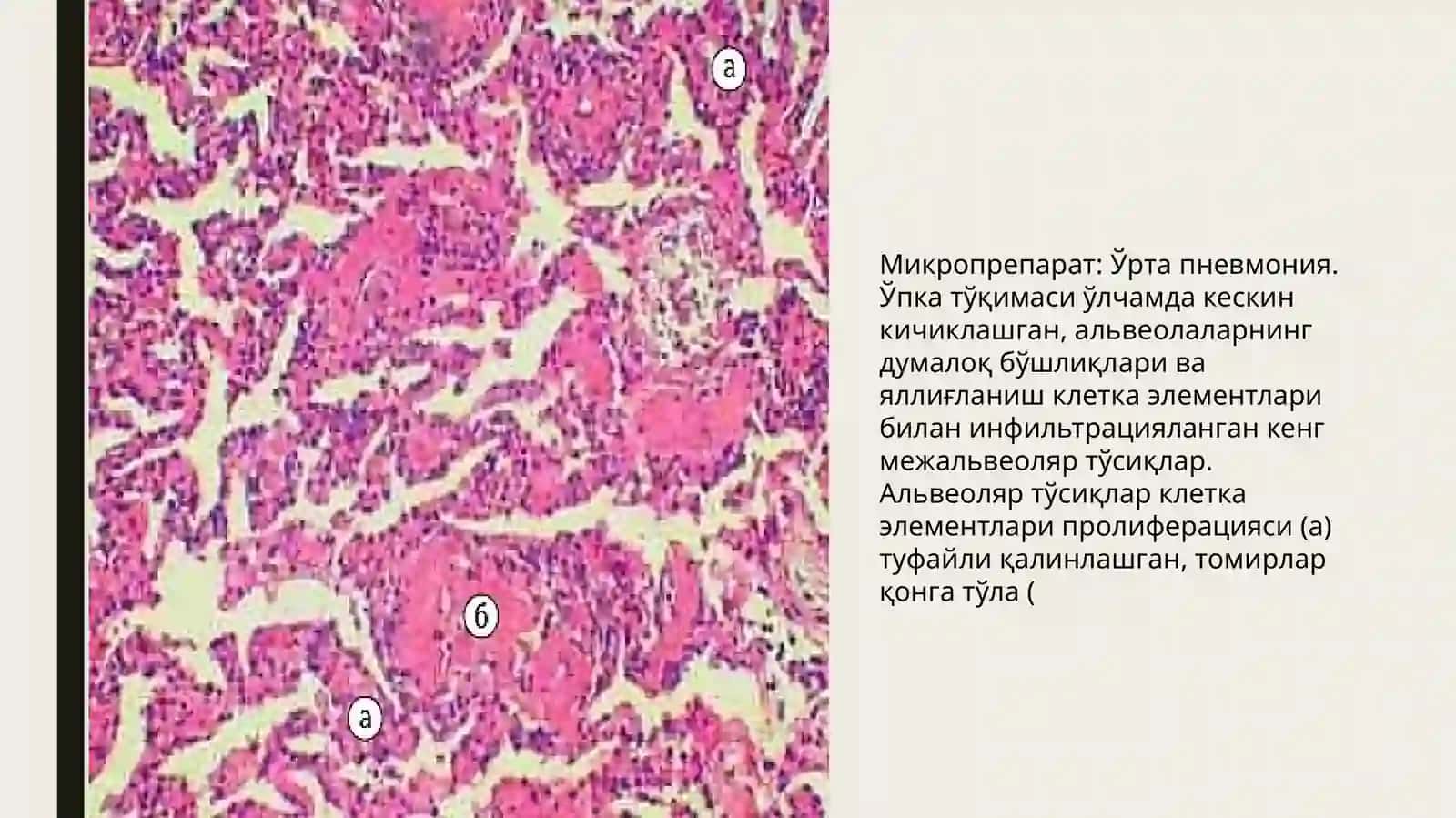 Макропрепарат: Сурункали атрофик гастрит. Микропрепарат: Буйрак амилоидози 4