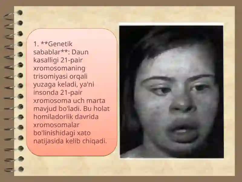 Daun sindromi 4