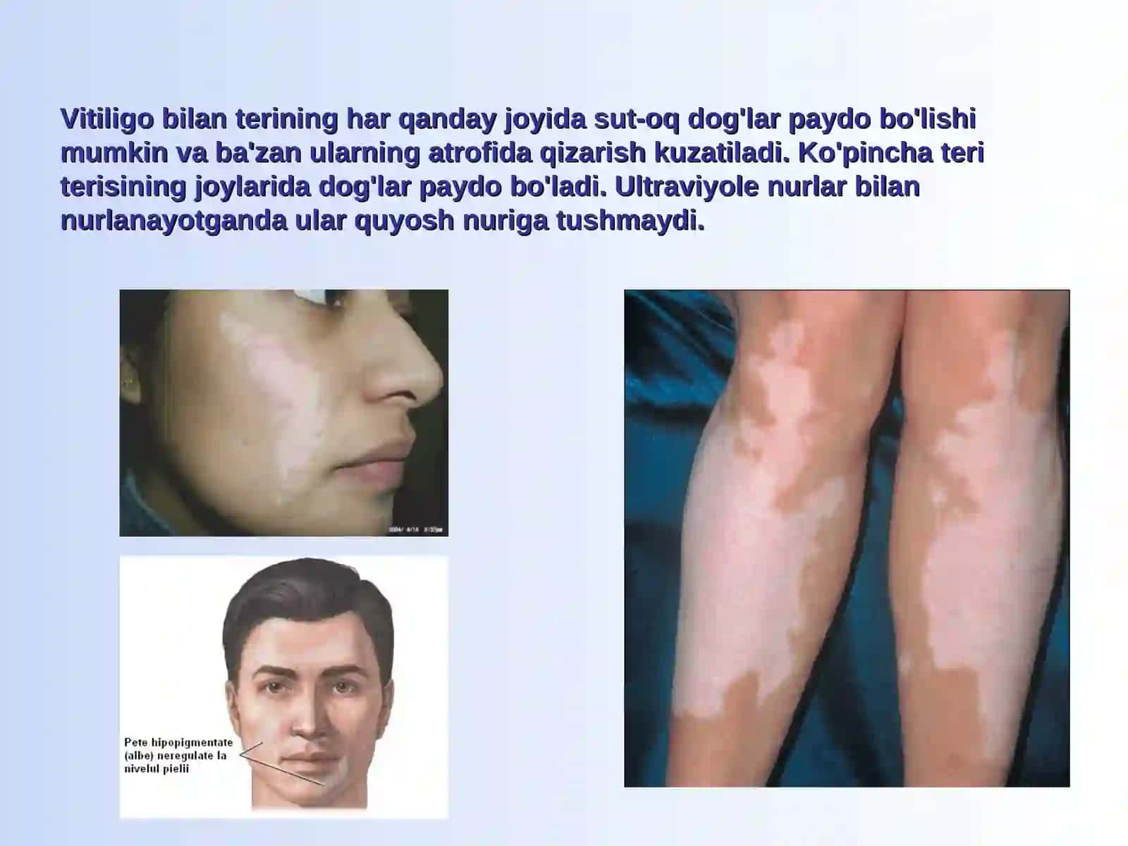 Vitiligo 4