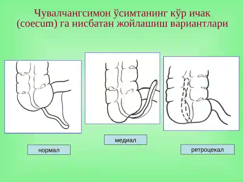 Ўткир аппендицит 4