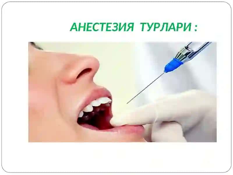 МАҲАЛЛИЙ АНЕСТЕТИКЛАР 4