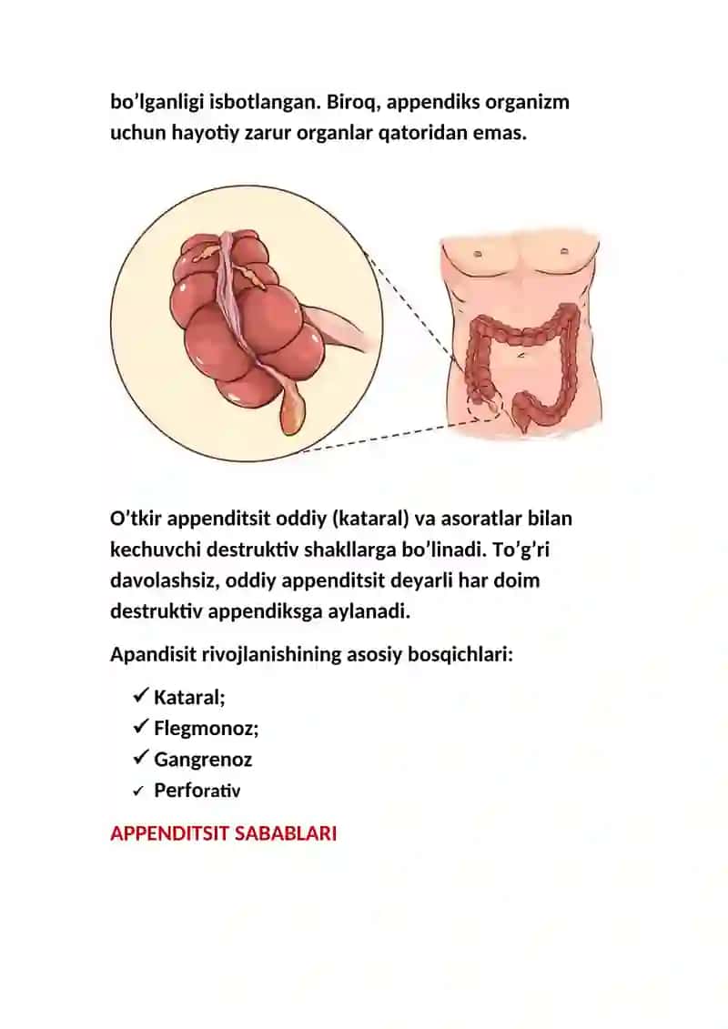 APPENDITSIT — TA’RIFI, TASNIFI, BELGILARI VA ALOMATLARI, TASHXISLASH VA DAVOLASH 4