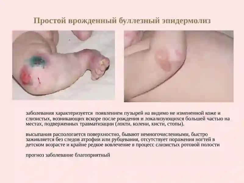 Буллезныйэпидермолиз 4