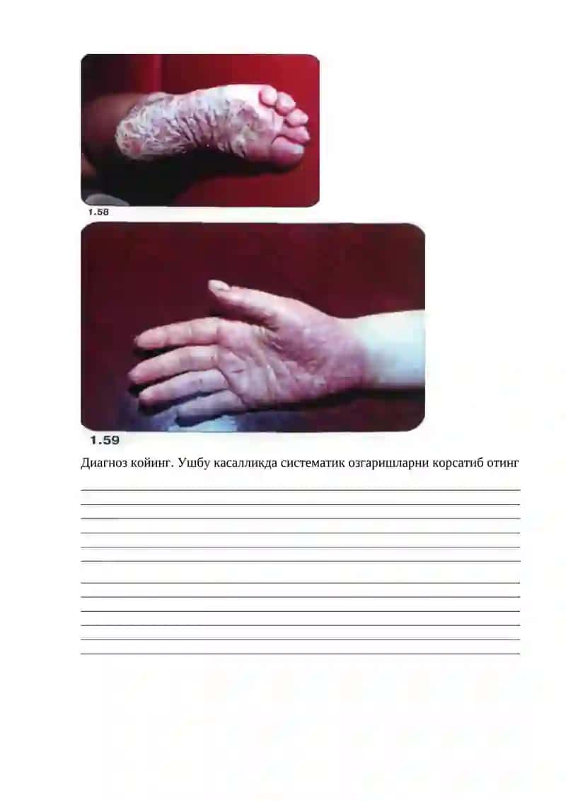 Bolalаrda parodontning idiopatik kasalliklari (Papiyon-Lefevr sindromi, X-gistiositoz, Osler, Itsenko-Kushing sindromlari) 4