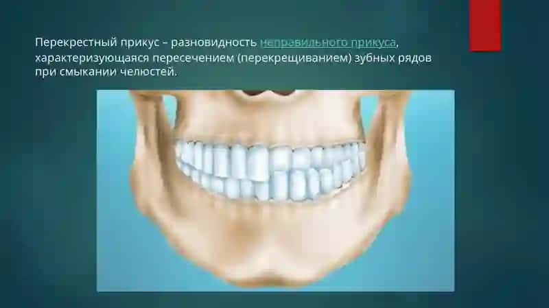 Перекрестный прикус 4