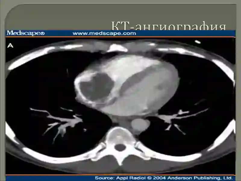 YURAK-QON TOMIRLARI KASALLIKLARIDA KOMPYUTER TOMOGRAFIYANING AXAMIYATI 4