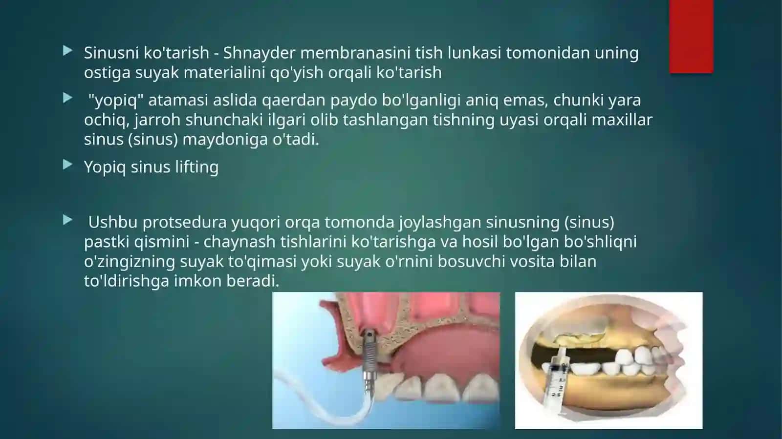 Sinuslifting operatsiyasiga ko’rsatma va qarshi ko’rsatmalar 4