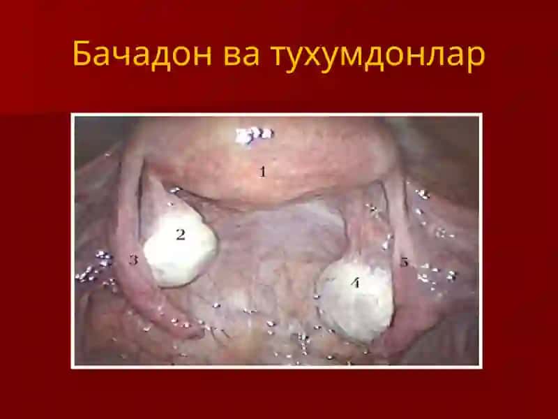 Тухумдон киста ва кистомалари 4