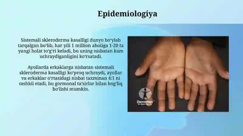 Tizimli Sklerodermiya 4