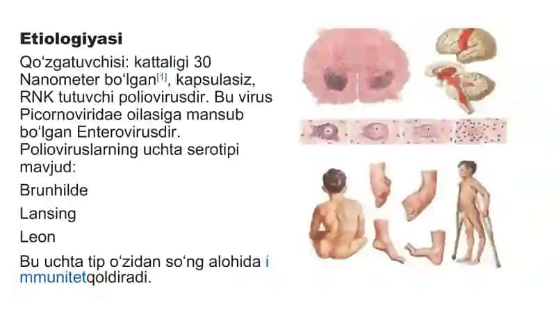 Poliomiyelit(yun. polios — kulrang va myelos — orqa miya) 4