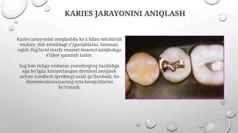 Stomatologiyada G.V Blek bo’yicha I-sinf tayyorlashning o’ziga xosligi 4