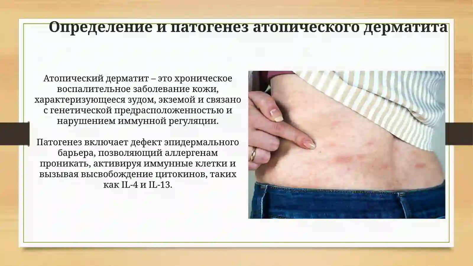 Крапивница и атопический дерматит: Клиническая картина и диагностика 4