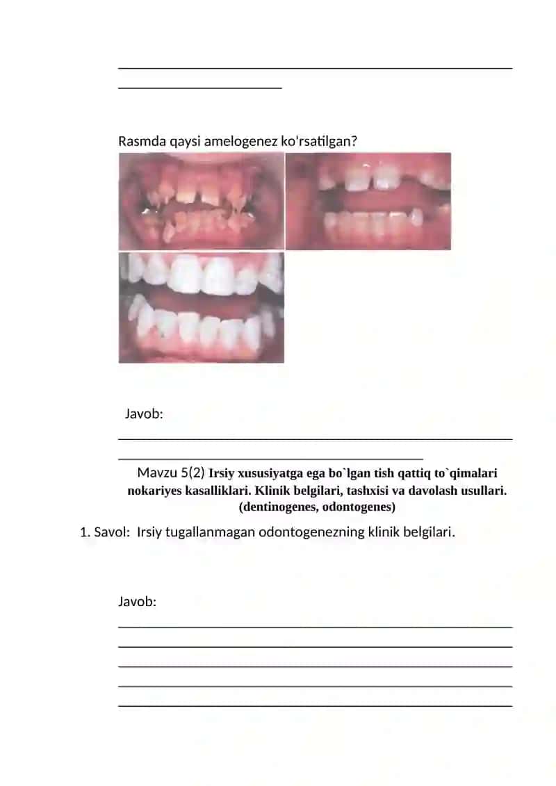 Irsiy xususiyatga ega bo`lgan tish qattiq to`qimalari nokariyes kasalliklari. Klinik belgilari, tashxisi va davolash usullari.(amelogenes) 4