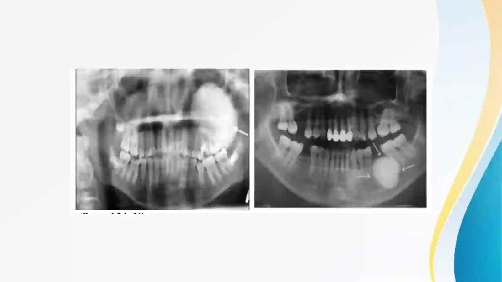 Xavfsiz osteogen o‘smalar. Klinikasi, tashxisi, davolash (osteoma, osteoid-osteoma, osteoblastoma, xondroma, osteoxondroma, gigant hujayrali o‘sma). 4