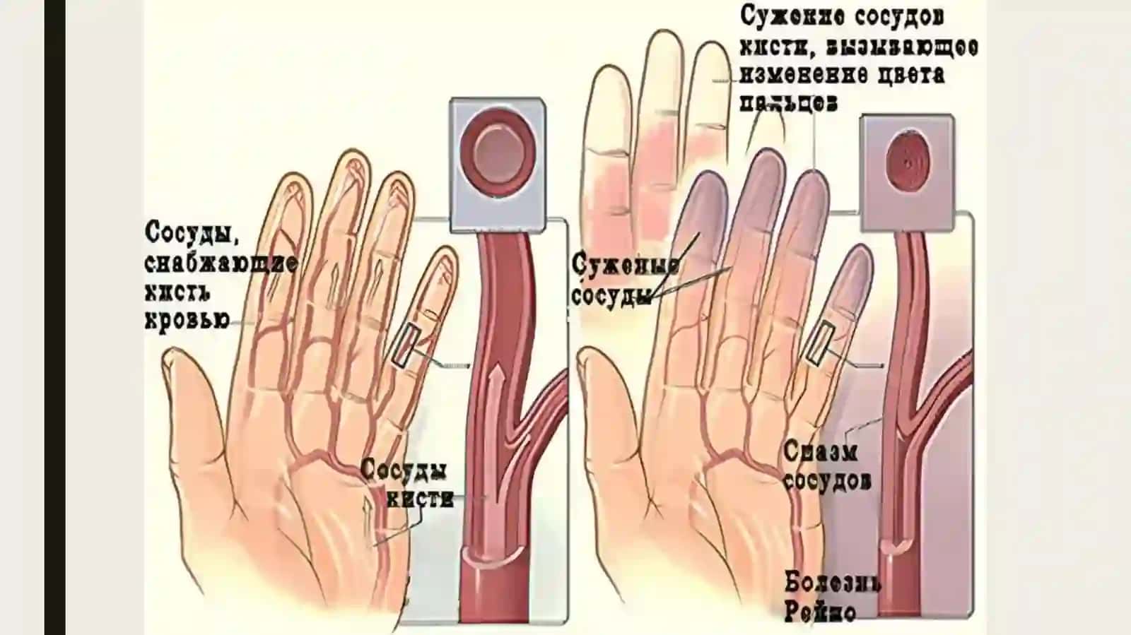 Qo‘l kritik ishemiyasi. Reyno kasalligi. 4