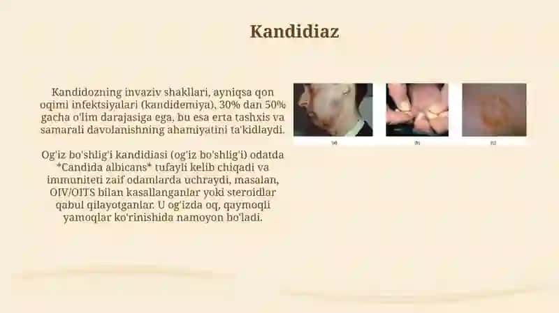 Zamburugʻ infeksiyalari (kandidoz, aspargillez) 4