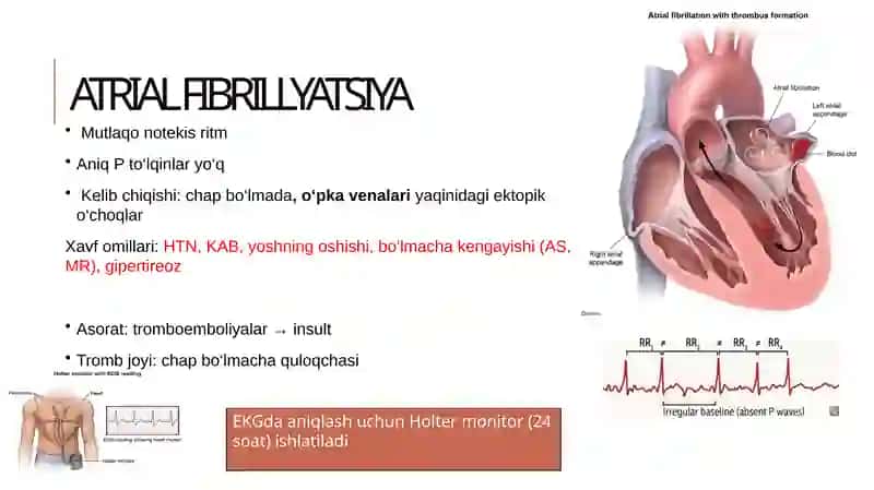 Atrial fibrillyatsiya 4