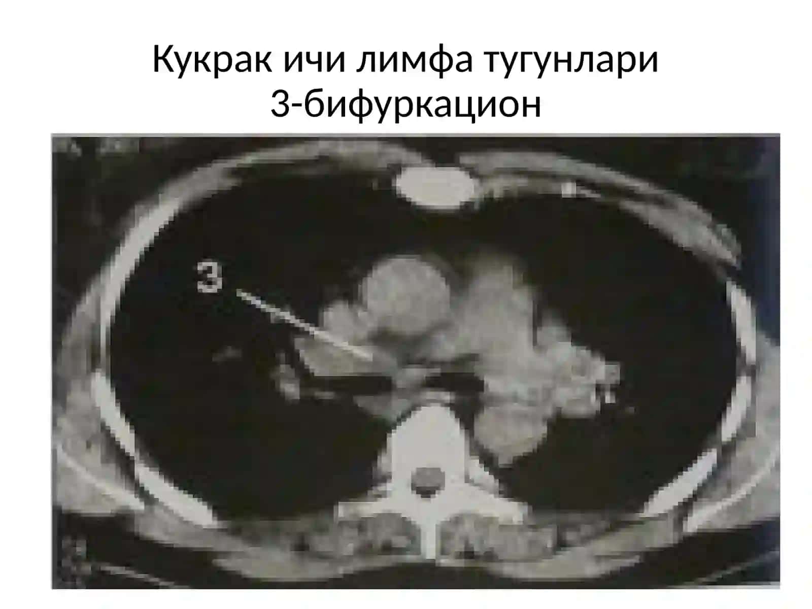 ФТИЗИАТРИЯБУЙИЧАРЕНТГЕНОГРАММАЛАР АЛЬБОМИ 4