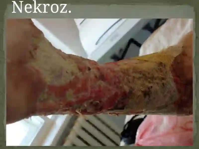 Mikrosirkulyator qon aylanishining buzilishi 4