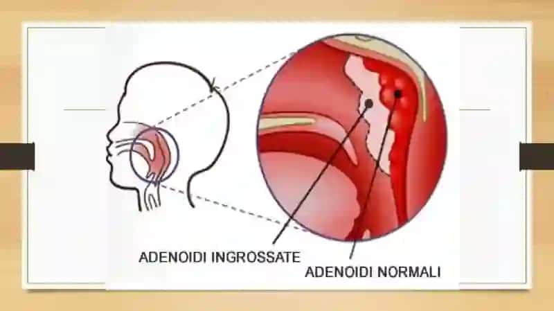 Adenoidlar 4