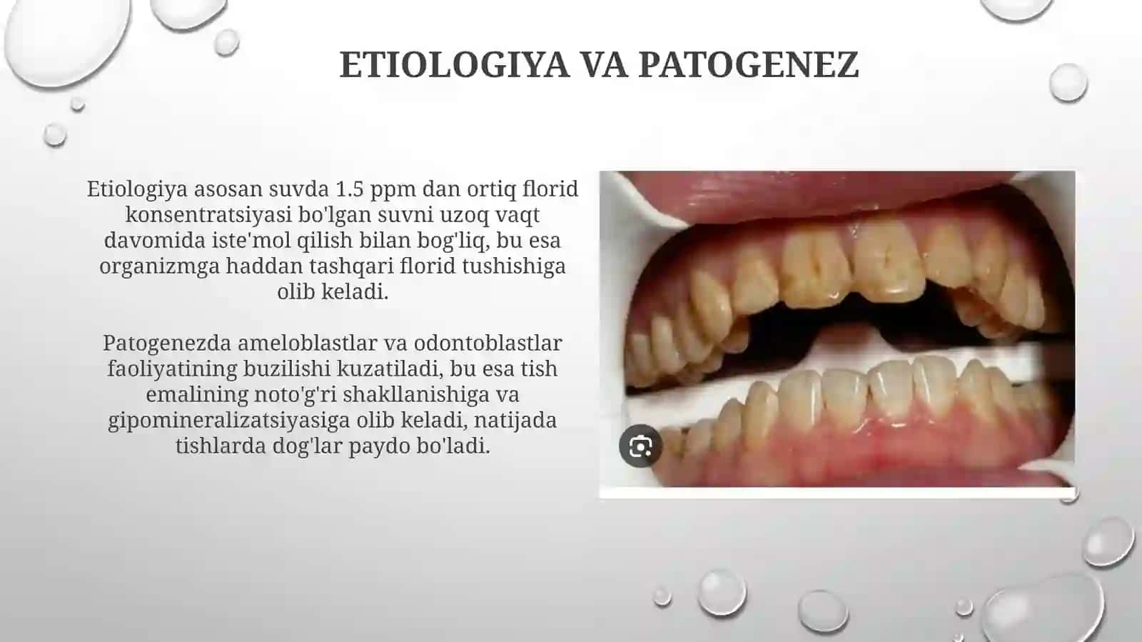 Endemikfluoroz 4