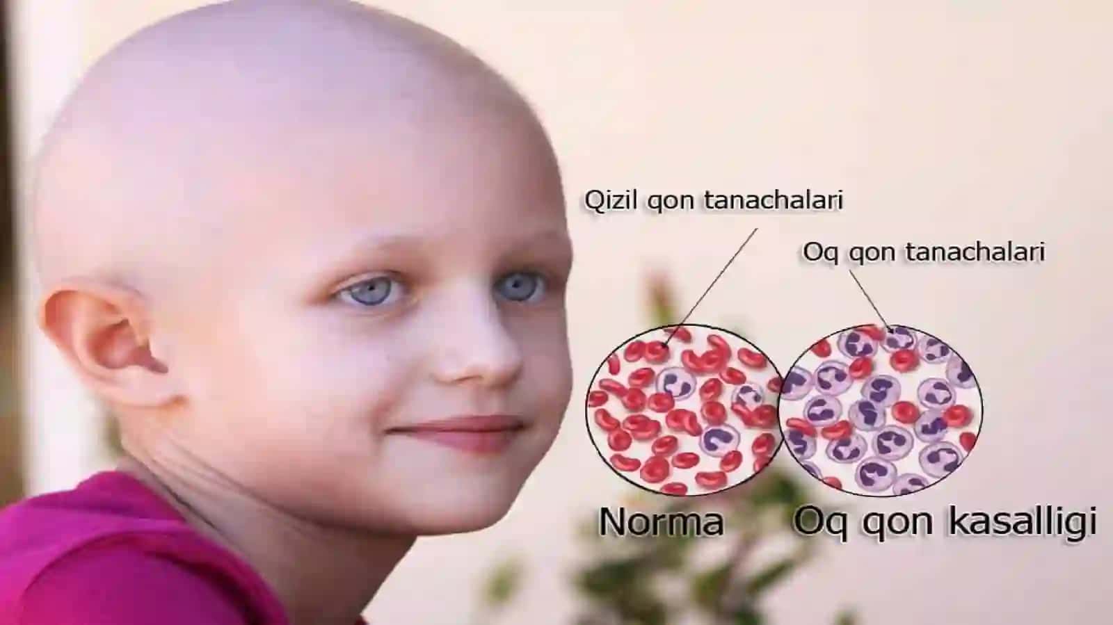 O‘TKIR LEYKOZ 4