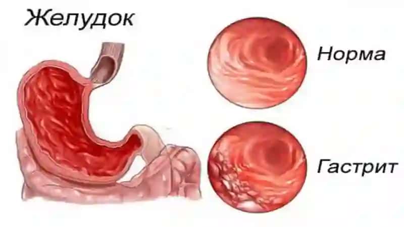 Gastirit Oshqozon ichak yarasi va kolit kelib chiqishida mikroorganizmlarning ahamiyati patogenizi labaratoriya tashxisi 4