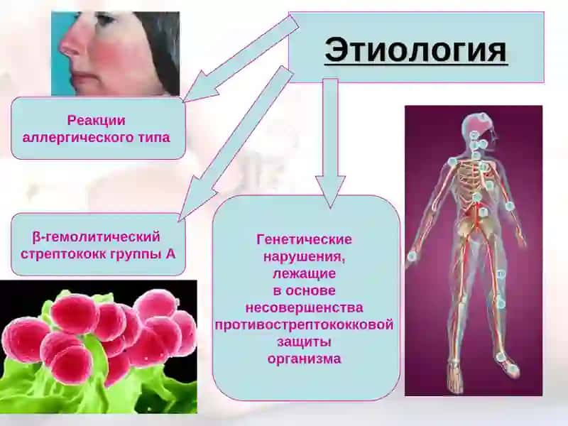 Ревматизм 4