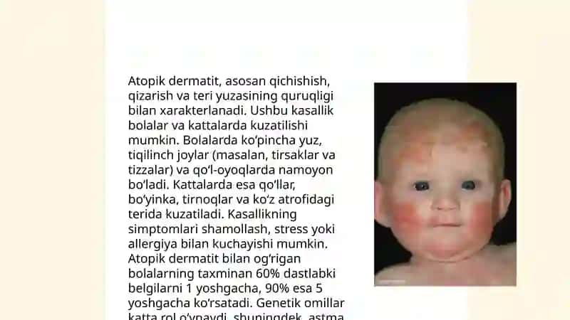 Atopik dermatit 4