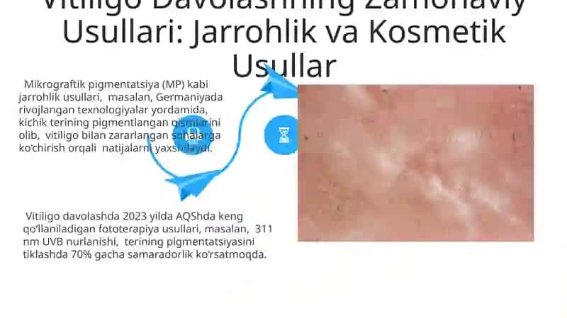 Dermatomiozitlar. Vitiligoning zamonaviy davo usullari 4