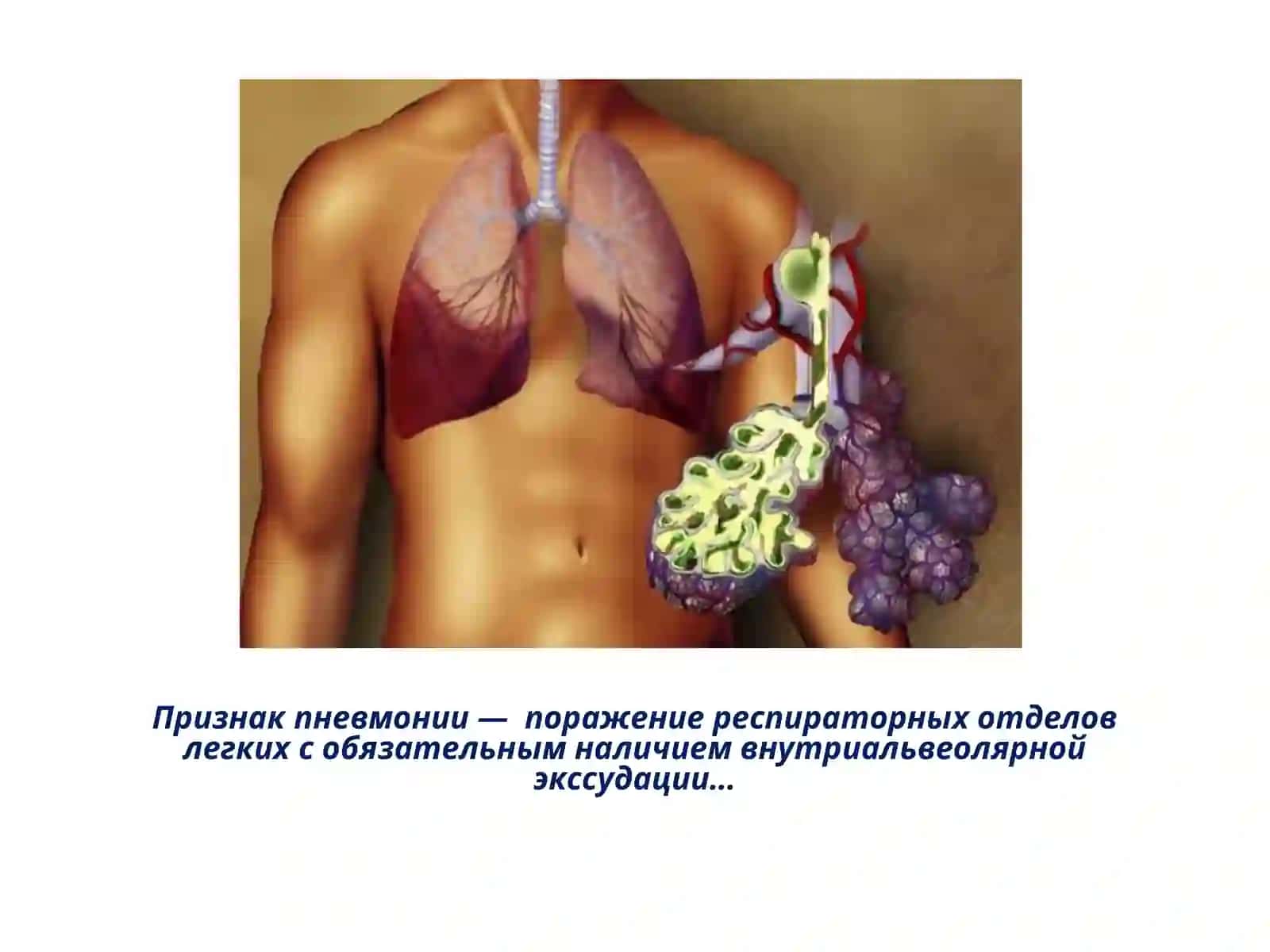 Пневмония (russkiy) 4