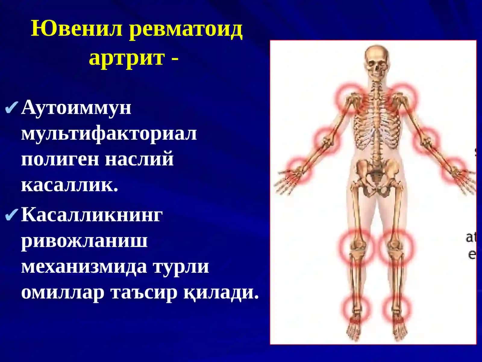Yuvenil revmatoid artrit 4