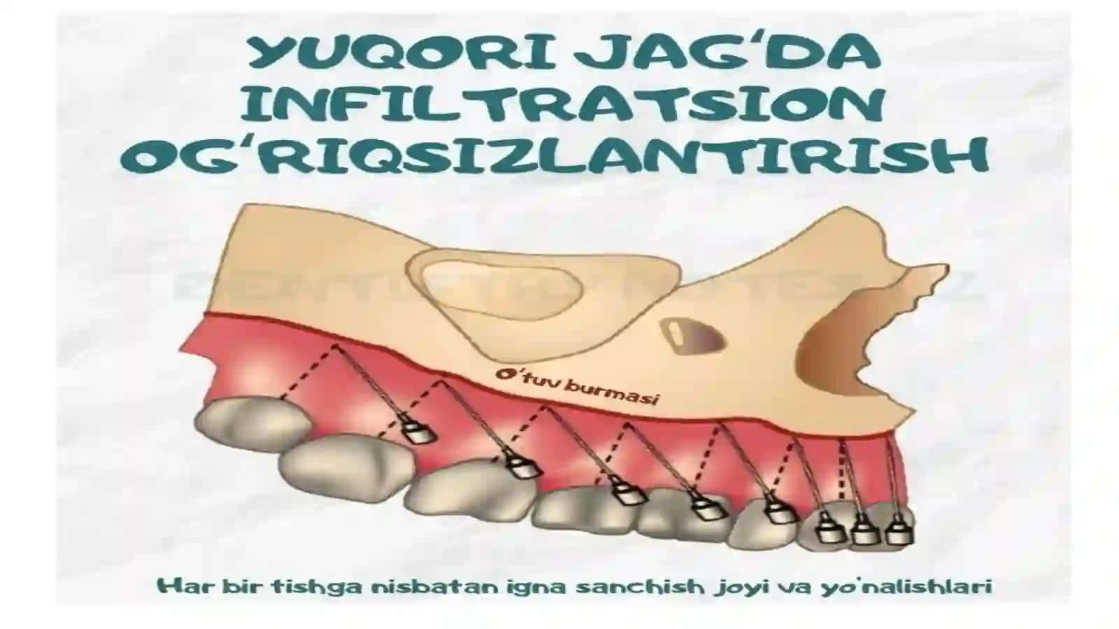 Yuqori jagda otkazilgan periferik ogriqsizlantirish usullari 4