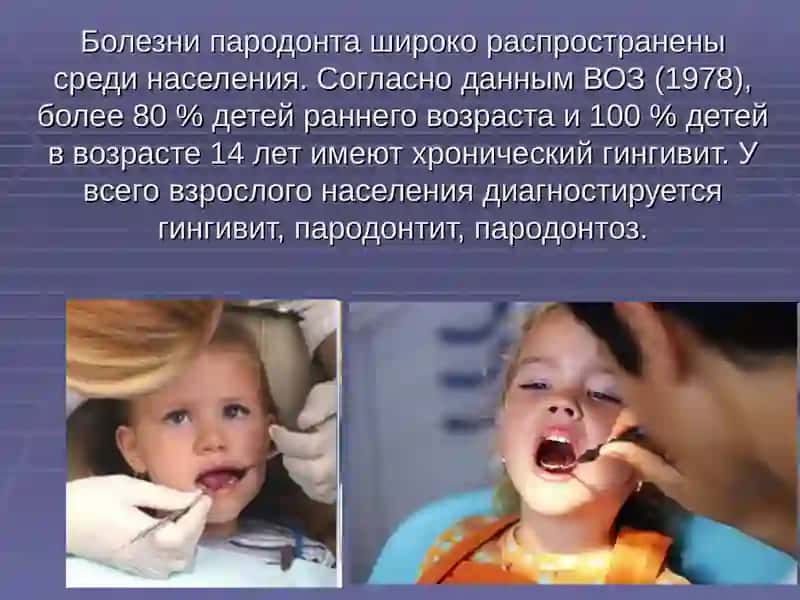 Болезни пародонта у детей 4
