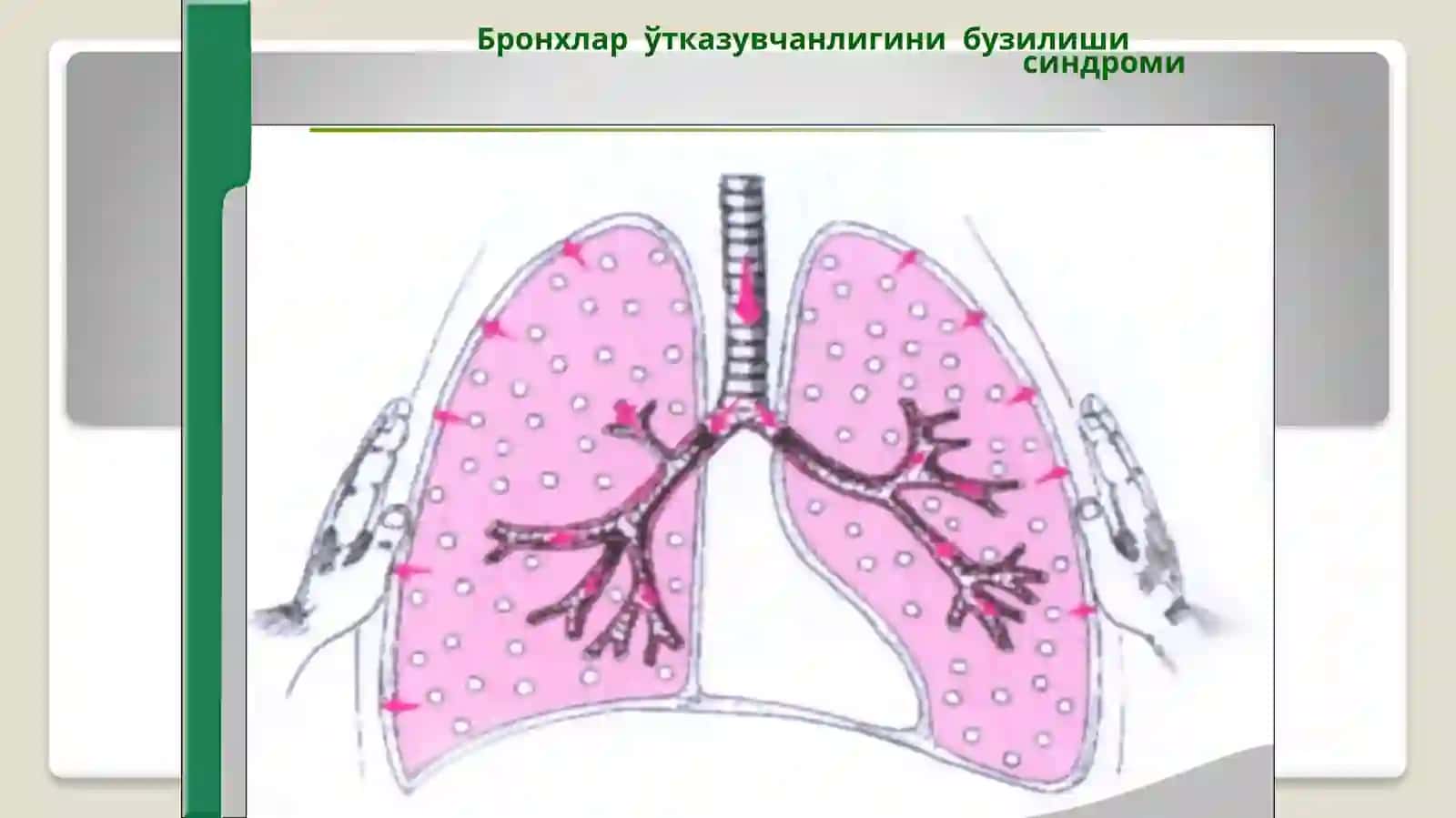 Нафас органлари касалликларидаги асосий клиник синдромлар 4