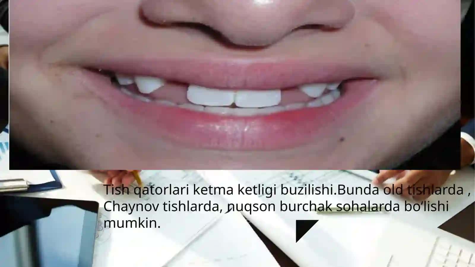 Tish qatorlari qisman nuqsonlari  klinikasi 4
