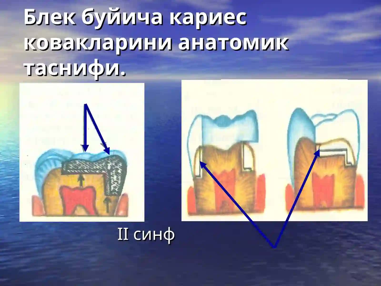 Кариес ковакларини чархлаш босқичлари ва услублари 4