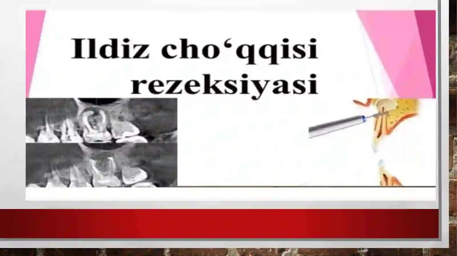 Surunkali periodontitni konservativ va hirurgik davolash 4