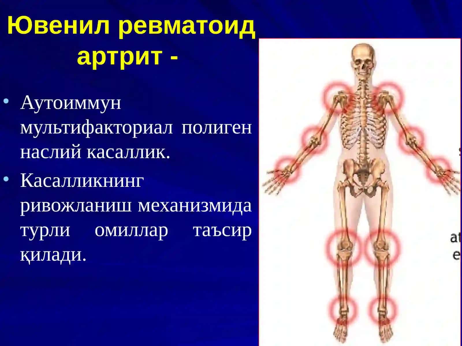 Ювенил ревматоид артрит 4